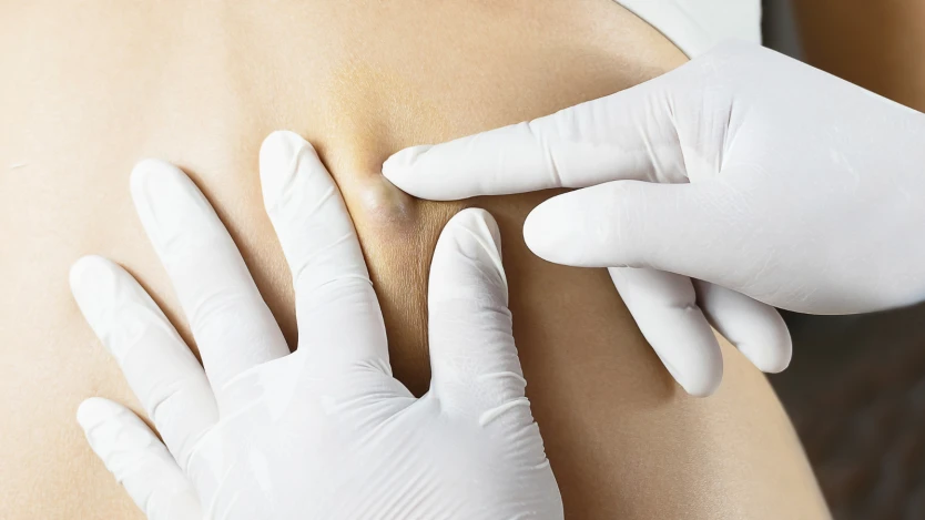 Cysts
