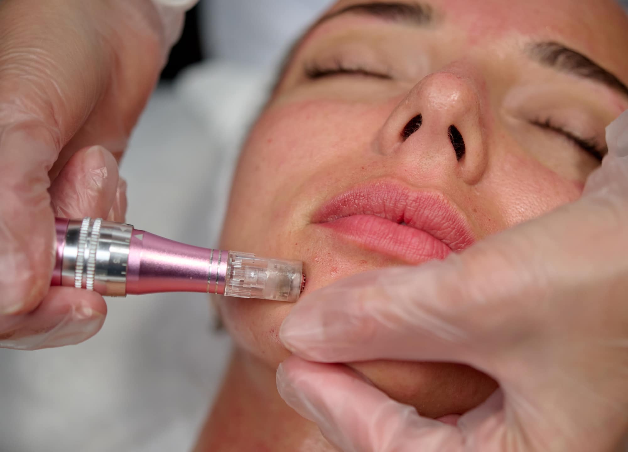 Skin Boosters