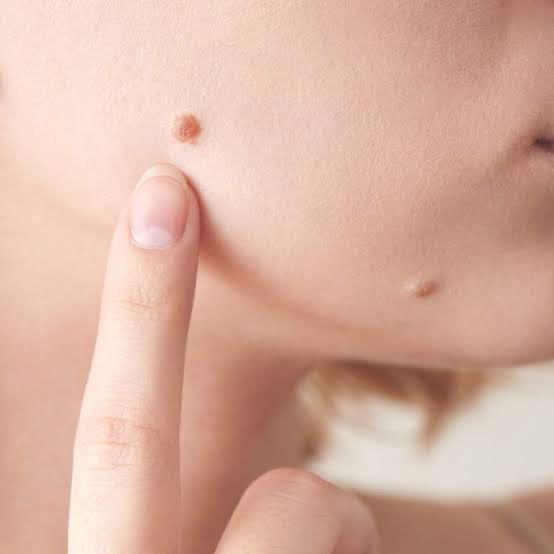 Mole & Benign Lesion Removal