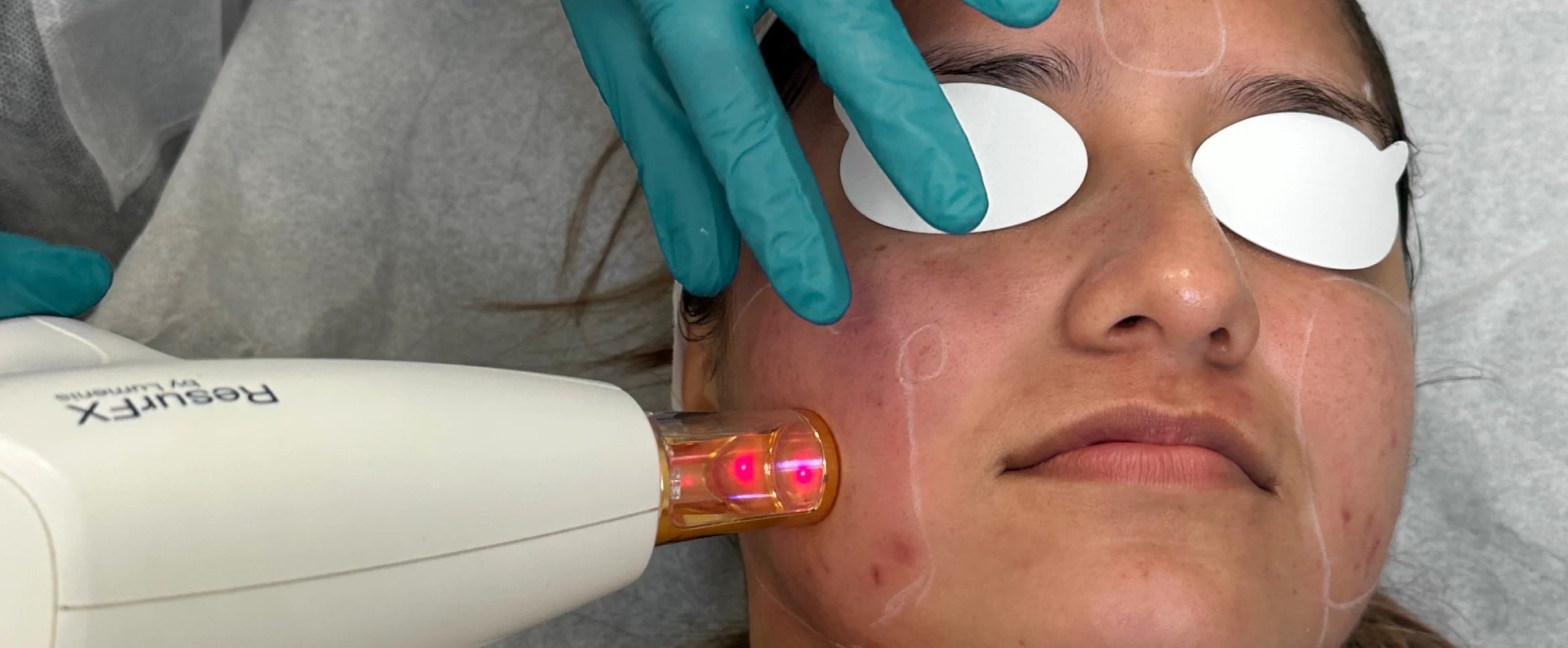 ResurFX laser skin resurfacing