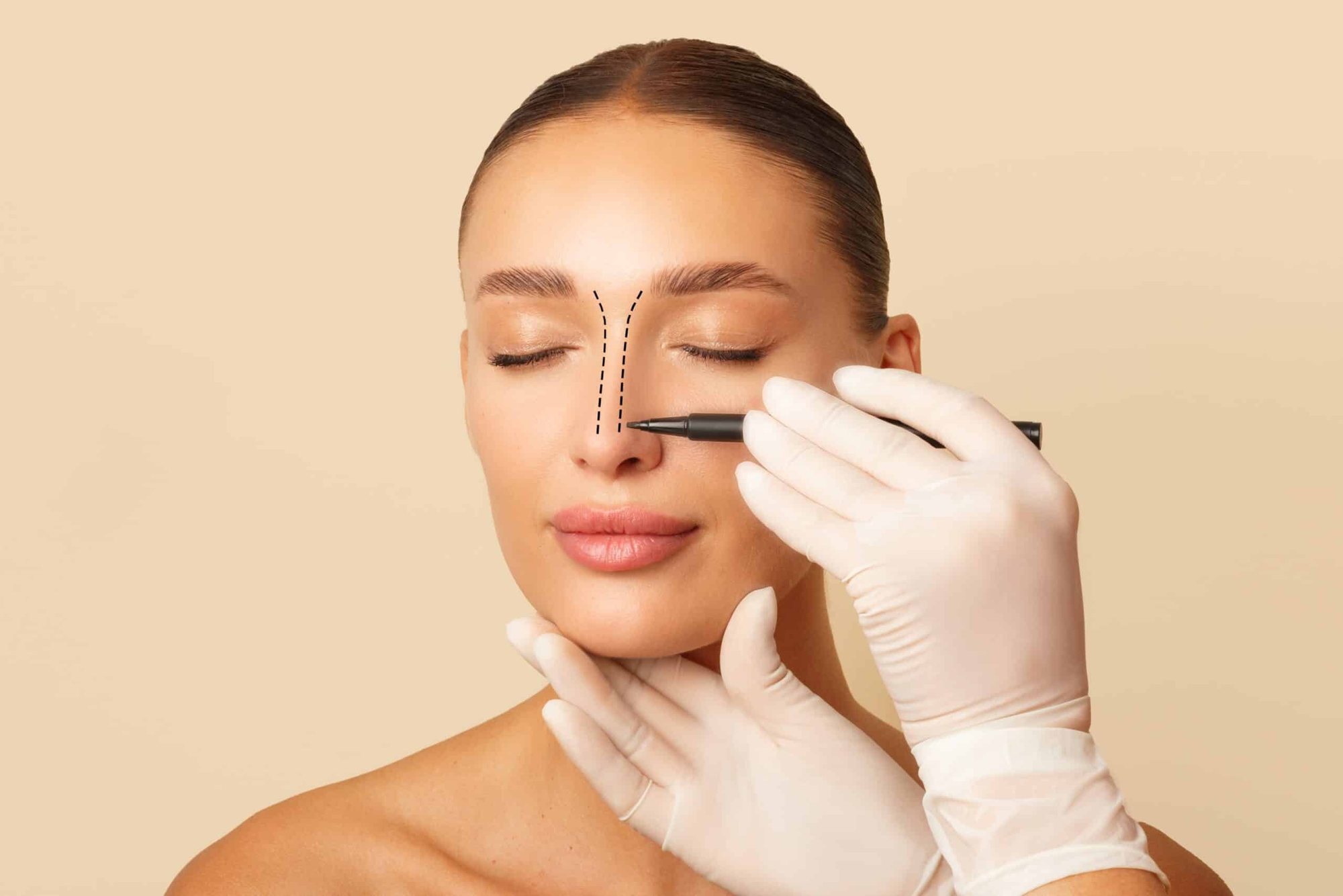 Rhinoplasty marking before surgery