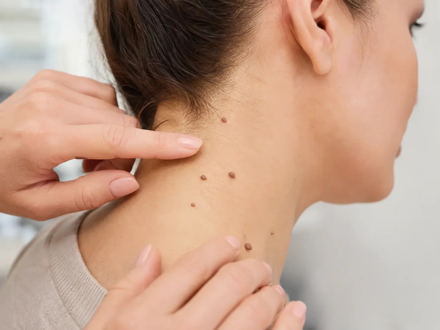 Skin Tags