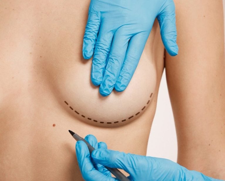 Surgeon marking the breast before plastic surgery